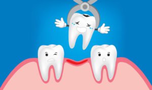 Tooth extraction concept