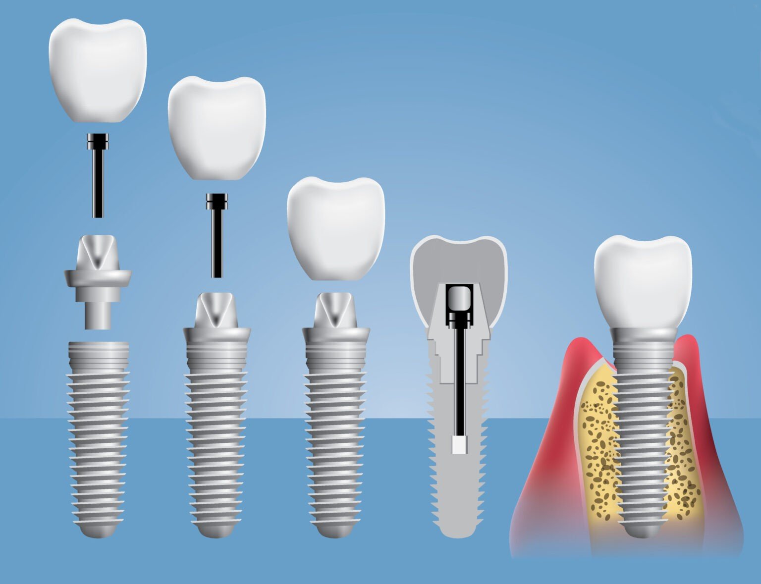 Зубные импланты: разновидности, особенности установки