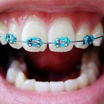 Брекеты для детей в семейной стоматологии Авеста