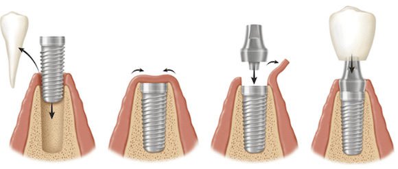 Имплантация зубов в Подольске