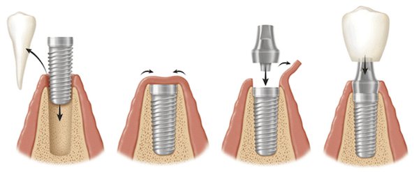 Имплантация зубов в Подольске