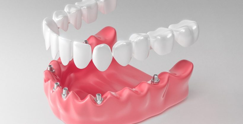 Протезирование зубов: разновидности протезов, когда стоит проводить процедуру?
